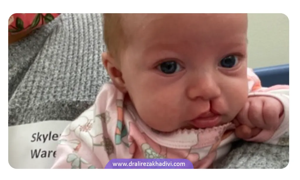 نوزاد مبتلا به شکاف لب یا Cleft lip