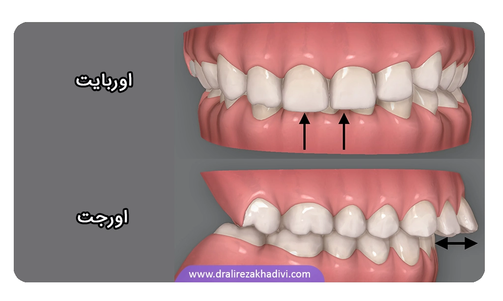 عکس مقایسه اورجت و اوربایت