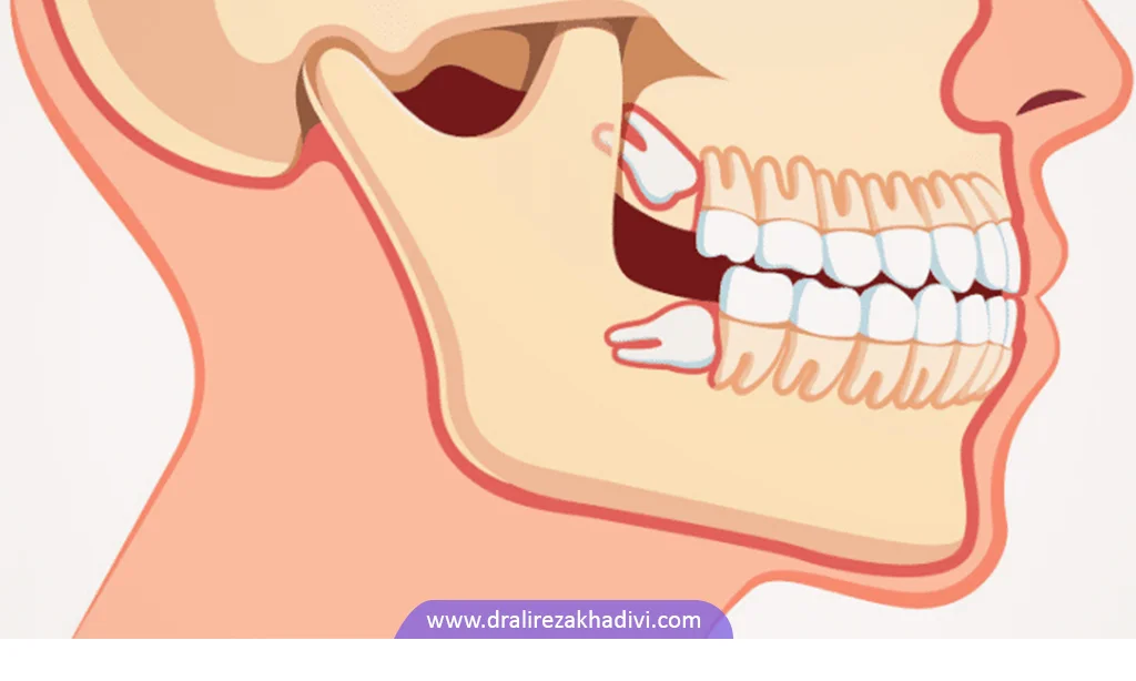 عکس دندان عقل نهفته فک پایین و بالا