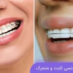 تفاوت ارتودنسی ثابت و متحرک