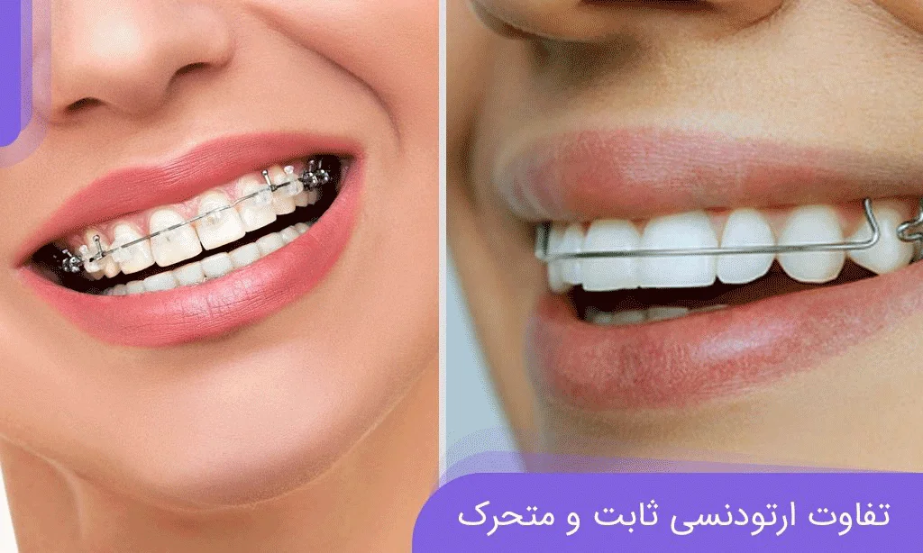 تفاوت ارتودنسی ثابت و متحرک