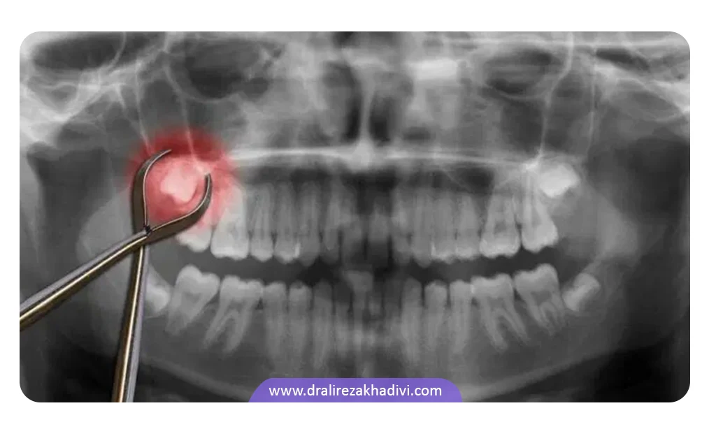 کشیدن دندان عقل قبل از ارتودنسی
