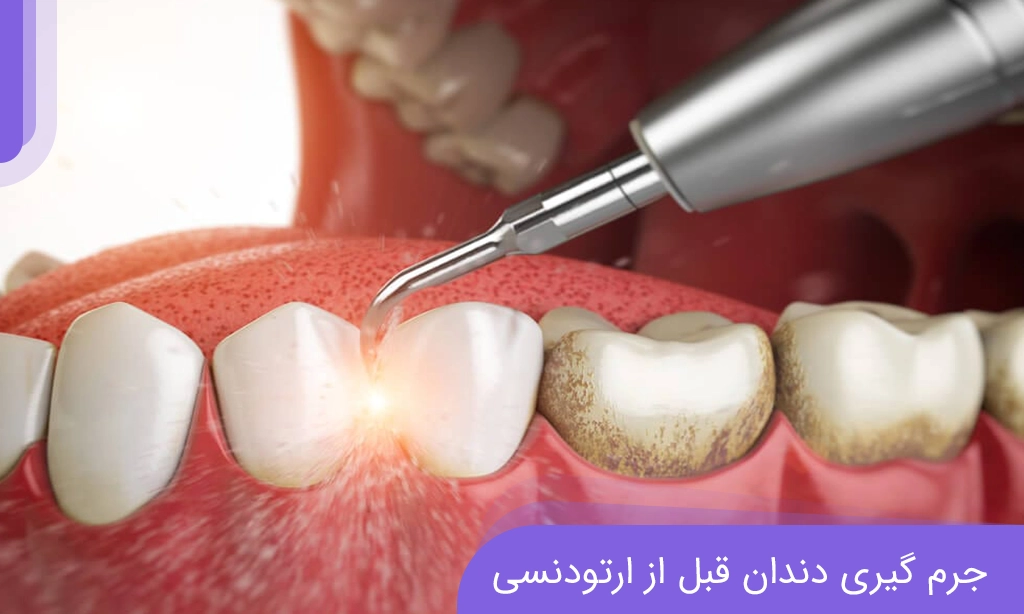 جرم گیری قبل از ارتودنسی دندان