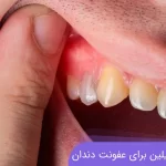 نحوه مصرف آموکسی سیلین و مترونیدازول برای عفونت دندان