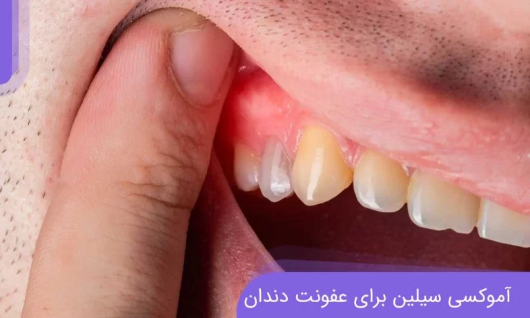 نحوه مصرف آموکسی سیلین و مترونیدازول برای عفونت دندان