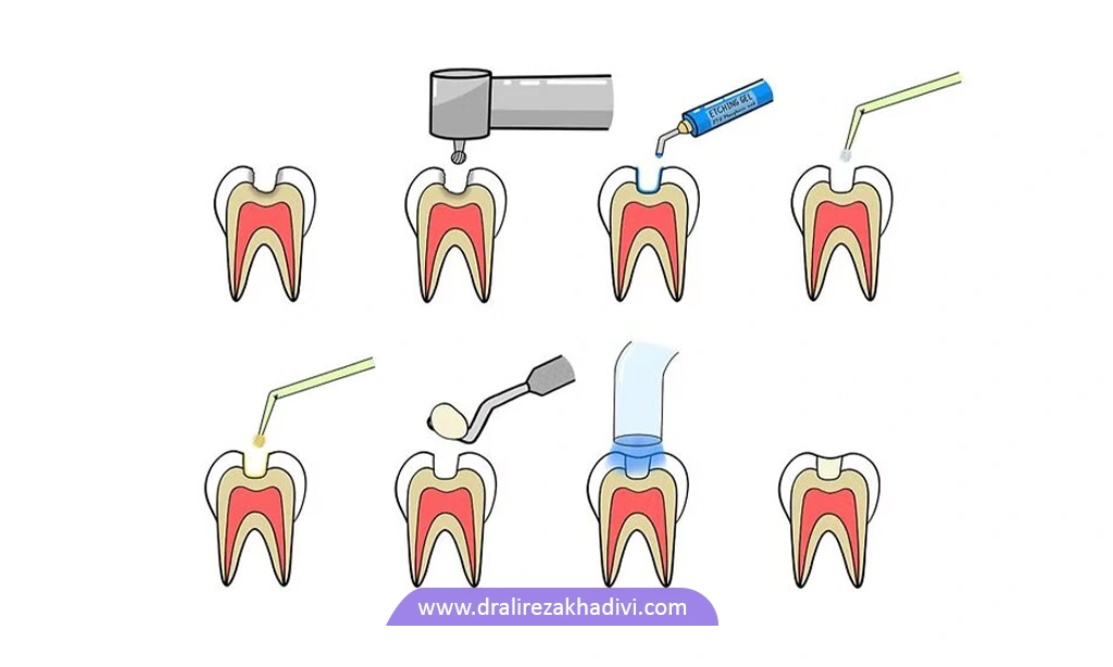 مراحل پر کردن دندان