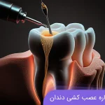 همه چیز درباره عصب کشی دندان