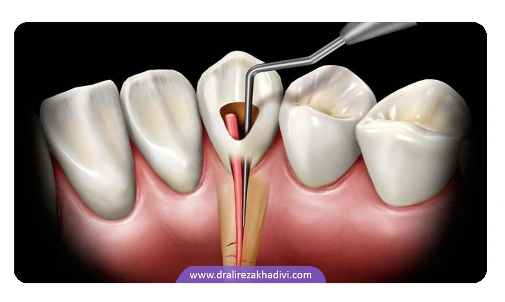 عصب کشی دندان چگونه انجام می‌شود